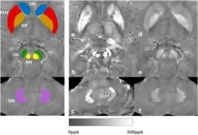 Wilson’s disease: Food therapy out of trace elements